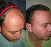 clinicas injerto capilar mendoza HAIR CLINIC/ Medicina Estetica Integral